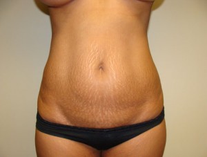 Tummy Tuck Before and After | Grover Aesthetics
