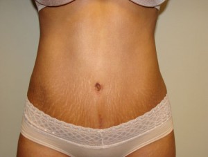 Tummy Tuck Before and After | Grover Aesthetics