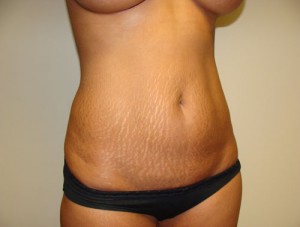 Tummy Tuck Before and After 88 | Grover Aesthetics