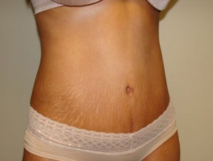 Tummy Tuck Before and After 88 | Grover Aesthetics