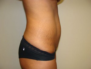 Tummy Tuck Before and After 88 | Grover Aesthetics