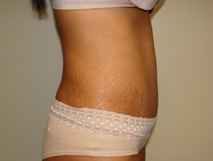 Tummy Tuck Before and After 88 | Grover Aesthetics