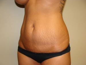 Tummy Tuck Before and After 88 | Sanjay Grover MD FACS