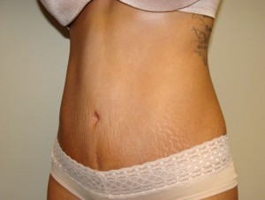 Tummy Tuck Before and After 88 | Grover Aesthetics
