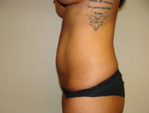 Tummy Tuck Before and After 88 | Grover Aesthetics