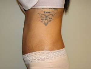 Tummy Tuck Before and After 88 | Grover Aesthetics