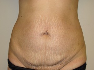 Tummy Tuck Before and After | Grover Aesthetics