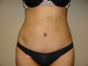 Tummy Tuck Before and After | Grover Aesthetics