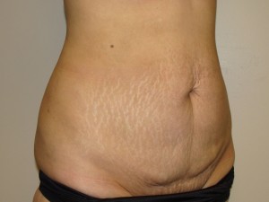 Tummy Tuck Before and After 89 | Sanjay Grover MD FACS