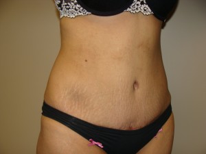 Tummy Tuck Before and After 89 | Grover Aesthetics