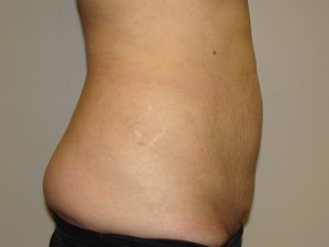 Tummy Tuck Before and After 89 | Sanjay Grover MD FACS