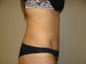 Tummy Tuck Before and After 89 | Sanjay Grover MD FACS