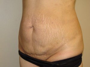 Tummy Tuck Before and After 89 | Sanjay Grover MD FACS