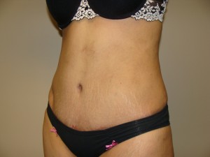 Tummy Tuck Before and After 89 | Sanjay Grover MD FACS