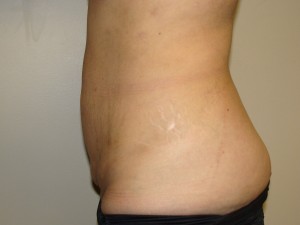 Tummy Tuck Before and After 89 | Grover Aesthetics