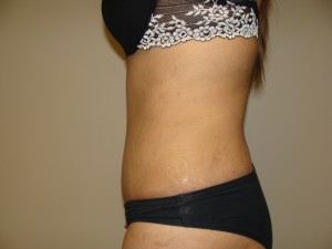 Tummy Tuck Before and After 89 | Sanjay Grover MD FACS