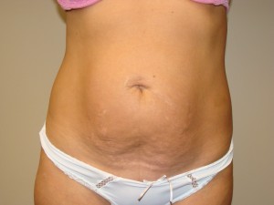 Tummy Tuck Before and After | Grover Aesthetics