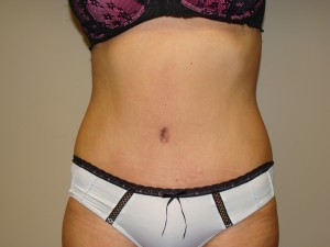 Tummy Tuck Before and After | Grover Aesthetics
