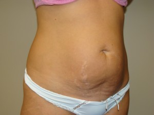 Tummy Tuck Before and After 90 | Grover Aesthetics