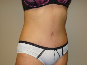Tummy Tuck Before and After 90 | Grover Aesthetics