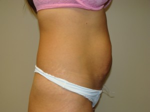 Tummy Tuck Before and After 90 | Grover Aesthetics