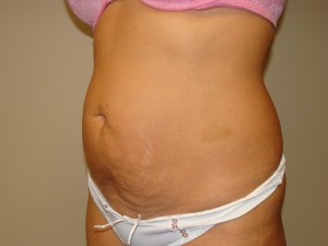Tummy Tuck Before and After 90 | Grover Aesthetics
