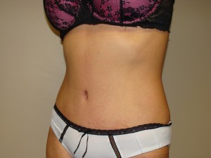 Tummy Tuck Before and After 90 | Grover Aesthetics