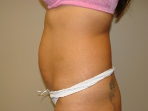 Tummy Tuck Before and After 90 | Grover Aesthetics