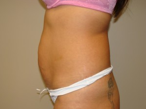 Tummy Tuck Before and After 90 | Sanjay Grover MD FACS