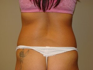 Tummy Tuck Before and After 90 | Grover Aesthetics