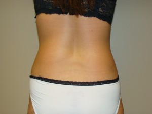 Tummy Tuck Before and After 90 | Grover Aesthetics