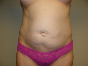 Tummy Tuck Before and After | Grover Aesthetics