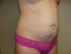 Tummy Tuck Before and After 91 | Grover Aesthetics
