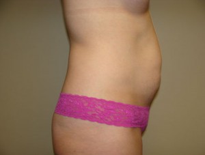 Tummy Tuck Before and After 91 | Sanjay Grover MD FACS