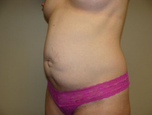 Tummy Tuck Before and After 91 | Grover Aesthetics