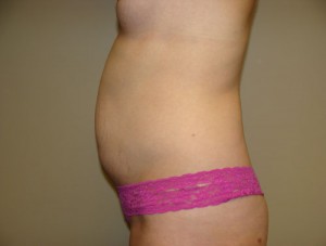 Tummy Tuck Before and After 91 | Grover Aesthetics