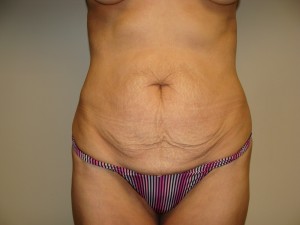 Tummy Tuck Before and After | Grover Aesthetics