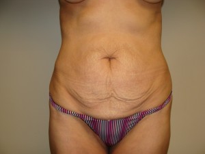 Tummy Tuck Before and After 80 | Sanjay Grover MD FACS