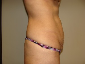 Tummy Tuck Before and After 92 | Sanjay Grover MD FACS