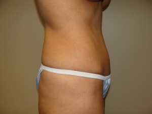 Tummy Tuck Before and After 92 | Grover Aesthetics
