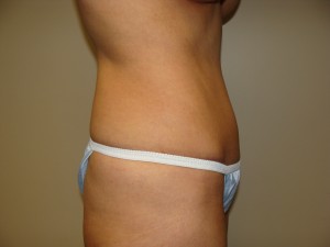 Tummy Tuck Before and After 92 | Sanjay Grover MD FACS