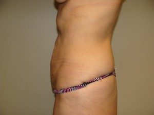 Tummy Tuck Before and After 92 | Sanjay Grover MD FACS