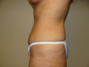 Tummy Tuck Before and After 92 | Sanjay Grover MD FACS