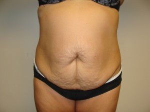 Tummy Tuck Before and After | Grover Aesthetics
