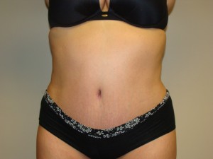 Tummy Tuck Before and After | Grover Aesthetics