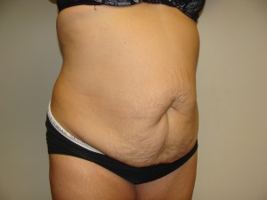 Tummy Tuck Before and After 93 | Sanjay Grover MD FACS