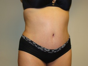 Tummy Tuck Before and After 93 | Sanjay Grover MD FACS