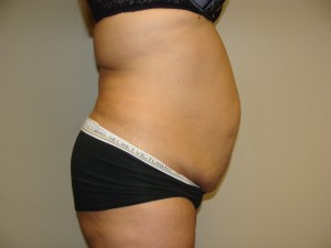 Tummy Tuck Before and After 93 | Sanjay Grover MD FACS