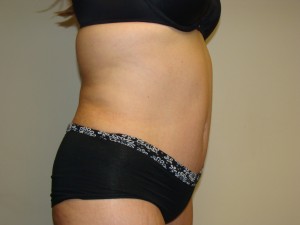 Tummy Tuck Before and After 93 | Sanjay Grover MD FACS