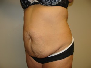 Tummy Tuck Before and After 93 | Sanjay Grover MD FACS